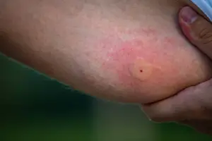 Close-up of a person's arm with a red